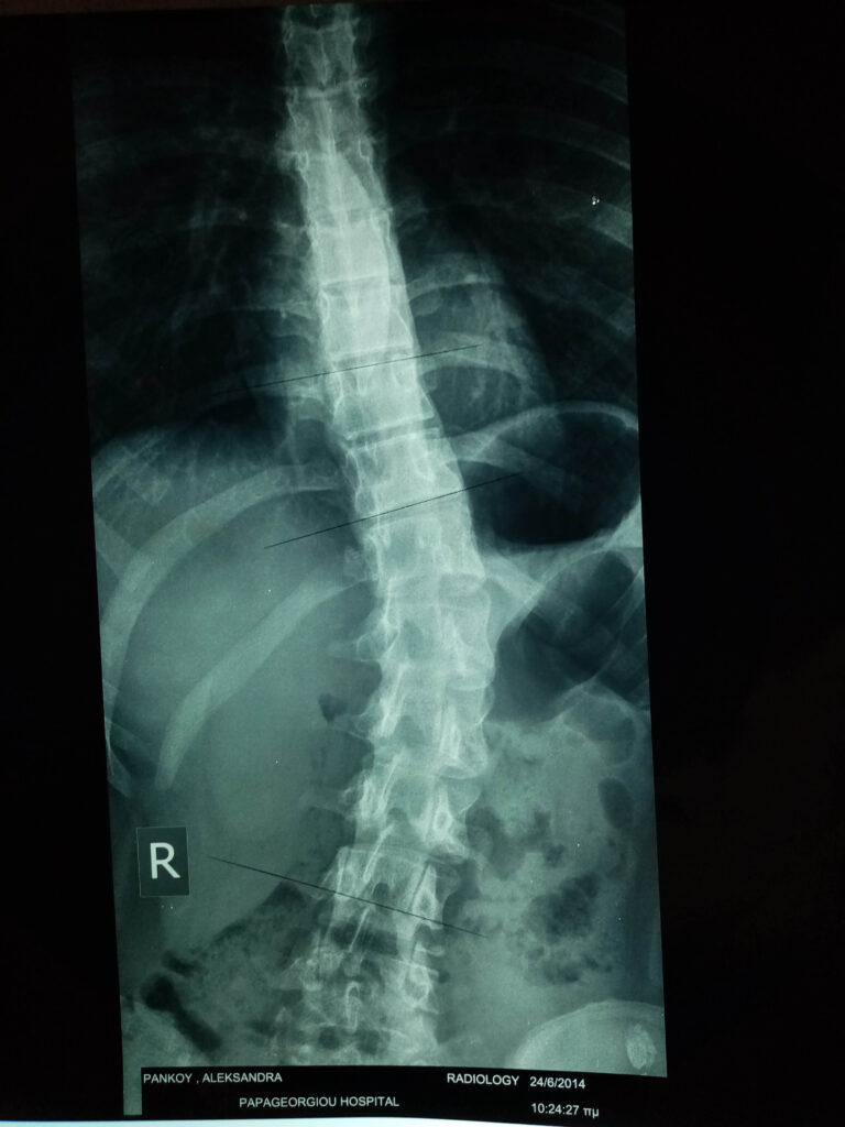 fisiokontos-scoliosis