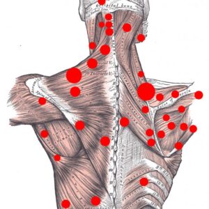 fisiokontos-trigger point